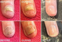 Detail poškozeného nehtu s onycholýzou v salonní praxi